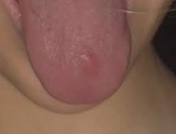 Was Ist Das Fur Ein Roter Fleck An Meiner Zunge Zahnarzt Mund Hno Arzt