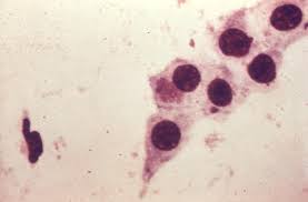 Image result for Chlamydia Trachomatis