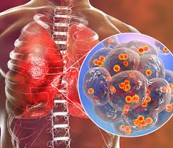 Image result for Pneumonia