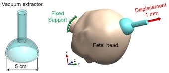 Image result for Vacuum Caput