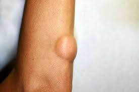 Dercum S Disease Connecting Lipomas To Fibromyalgia