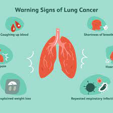 Is My Cough A Lung Cancer Cough