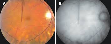 Scielo Brasil Birdshot Retinochoroidopathy Review Birdshot Retinochoroidopathy Review