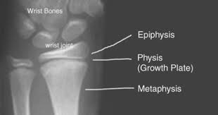 Growth Plate Injuries Physeal Fractures By Dr David Nelson Nuclear Medicine Medical Illustration Radiology
