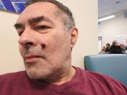 A renal transplant patient who has been taking cyclosporine for a number of  years presents with a small, hard lesion