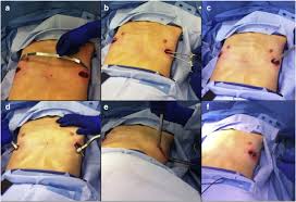 Maybe you would like to learn more about one of these? Perioperative Strategies And Technical Modifications To The Nuss Repair For Pectus Excavatum In Pediatric Patients A Large Volume Single Institution Experience Journal Of Pediatric Surgery