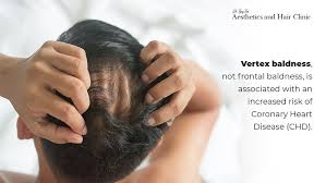 Find vertex from a vast selection of hair loss treatments. 4 Reasons Why Hair Loss Is Associated With High Blood Pressure