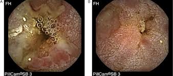 Image result for Intestinal Enteropathy