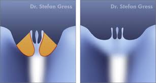Anatomische aufgabe der inneren schamlippen ist es, den scheideneingang abzudecken und die scheide vor fremdkörpern, austrocknung und dem eindringen von bakterien zu schützen. Schamlippe Verjungen Modellierung Der Ausseren Schamlippen