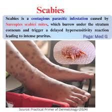 Image result for scabies transmission