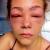 Allergic Just For Men Lawsuit