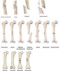 Types Of Fractures Medical Orthopedic Nursing Medical Education