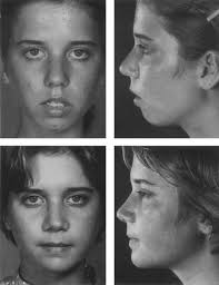 The Long Face Syndrome and Rhinoplasty