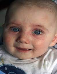 Eczema Cure Baby Food Allergies Most Common Food Allergies Common Food Allergies