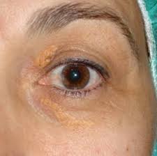 Image result for xantelasma