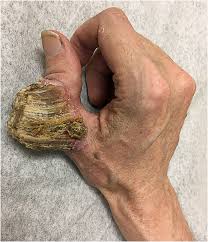 Image result for cornu cutaneum)