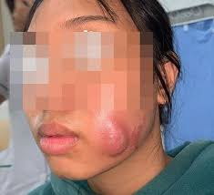 Biểu hiện má lúm đồng tiền bị hỏng và cách khắc phục