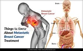 I think it's important for early stage patients to know the warning signs of metastatic disease. Things To Know About Metastatic Breast Cancer Treatment