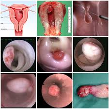 Namun begitu hidung tersumbat boleh terjadi disebabkan pelbagai perkara. Polip Endometrium Dr R Juhaidah Blog