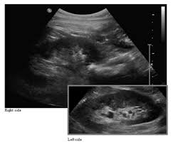 Image result for Postrenal Failure