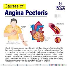 Image result for Angina Pectoris