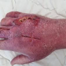 Image result for wolf spider bite skin