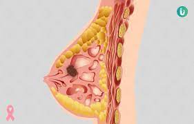 Possible symptoms of male breast cancer include: Breast Cancer Symptoms Causes Treatment Medicine Prevention Diagnosis