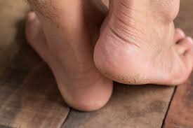 Cracked Heels Diabetics Foot Doctor For Diabetics Corona