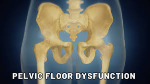 Image result for Pelvic Floor Dysfunction
