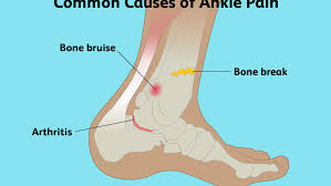What kind of exercises should you incorporate in your daily life? Everything You Need To Know About Ankle Pain
