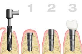 Here you may to know how to repair a loose tooth. 4 Reasons Why Your Dental Implant Might Be Failing