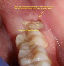 Pericoronitis Wisdom Teeth Dentist Orange West Haven Woodbridge Ct Wisdom Teeth Wisdom Teeth Aftercare Tooth Extraction Aftercare