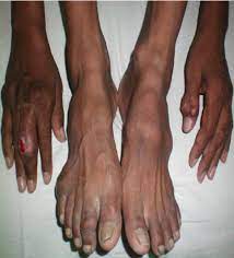 Two case furthermore, the patient had an additional lump in his left elbow. Multiple Gouty Tophi Download Scientific Diagram