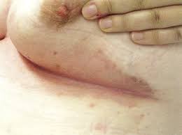 Sep 03, 2019 · some people find relief with a vinegar treatment for intertrigo. Erythrasma Amboss