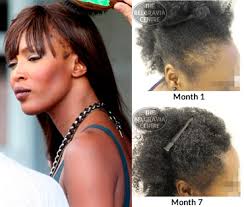 Hair units can be used for women also. Black Models Hair Loss Caused By Lack Of Afro Hair Knowledge