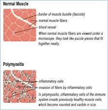 Image result for Polymyositis