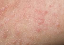 Itchy Bumps Filled With Clear Liquid Causes And Treatment