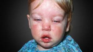 Image result for vyrážka u dětí