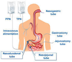 Routes Of Enteral Feeding The Best Requirement For Enteral Feeds Is 30 Calories Kg 1g Kg Of Protein P Dysphagia Therapy Nursing Notes Speech And Language