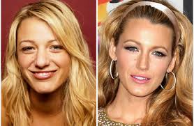 Blake lively und ryan reynolds erwarten ihr drittes kind. Blake Lively Plastische Chirurgie Schonheitsbehandlungen Prominente Plastische Chirurgie