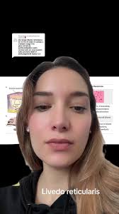 Diferencias entre Líbido Reticularis y Rasemoso