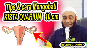 Obat herbal miom zaidul akbar. Cara Mengobati Kista Ovarium 10 Cm Dr Zaidul Akbar Youtube