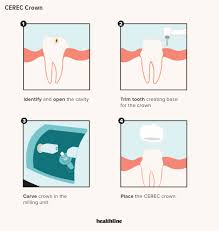 But there is still a large amount of confusion as to the options and features of the various materials and styles of crown. Cerec Crown Benefits Cons Costs Procedure And Alternatives