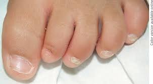 Image result for Koilonychia feet