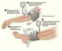 Use of ankle brachial pressure index to predict cardiovascular events and death: Ankle Brachial Pressure Index Wikipedia