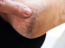 Treat cracked heels in winter at home with these methods. 20 Easy Home Remedies For Cracked Heels That Work Styles At Life