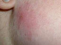 Pickel und reizungen an den schamlippen und im gesamten intimbereich sind lästig und unangenehm. Ist Das Ein Pickel Oder Hat Es Was Mit Einem Lymphknoten Zu Tun