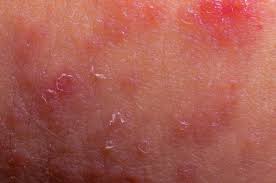In some cases, the condition will not always be. Skin Diseases List Of Common Conditions And Symptoms