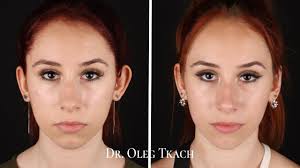 Результат пластики ушей 👂