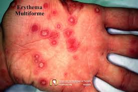 Image result for Erythema Multiforme Major